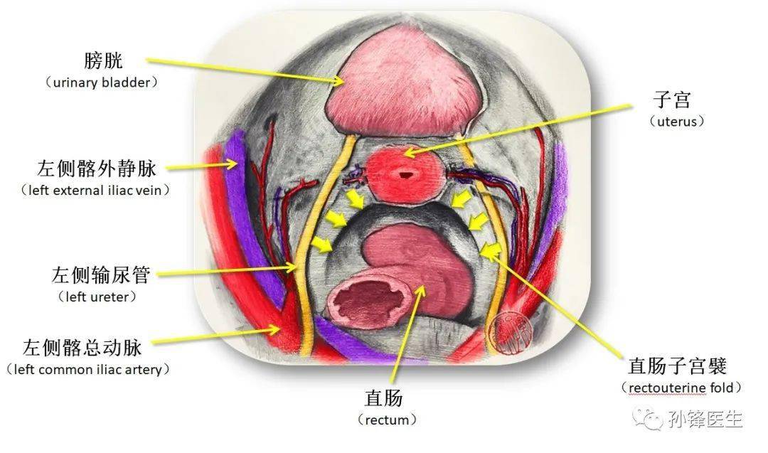 子宫直肠窝图片位置图片