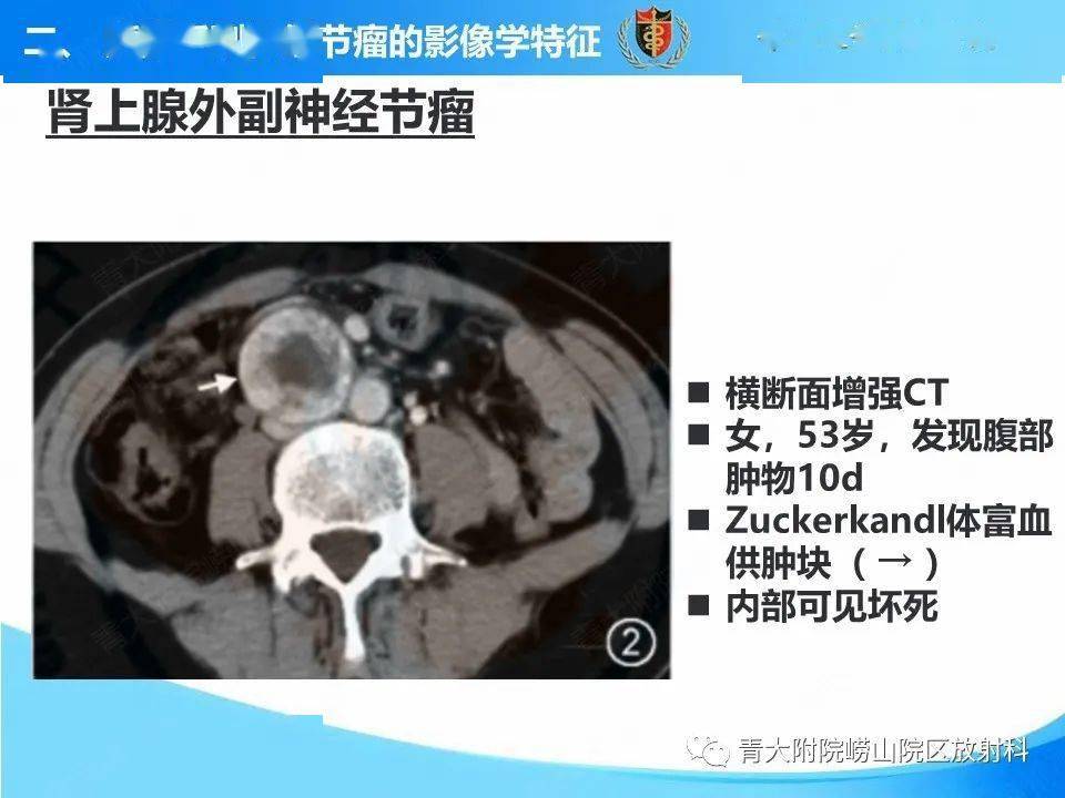 腹膜后副神经节瘤的影像学诊断与鉴别诊断