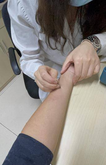 对紫外线过敏不是矫情这些变态反应最严重会致休克