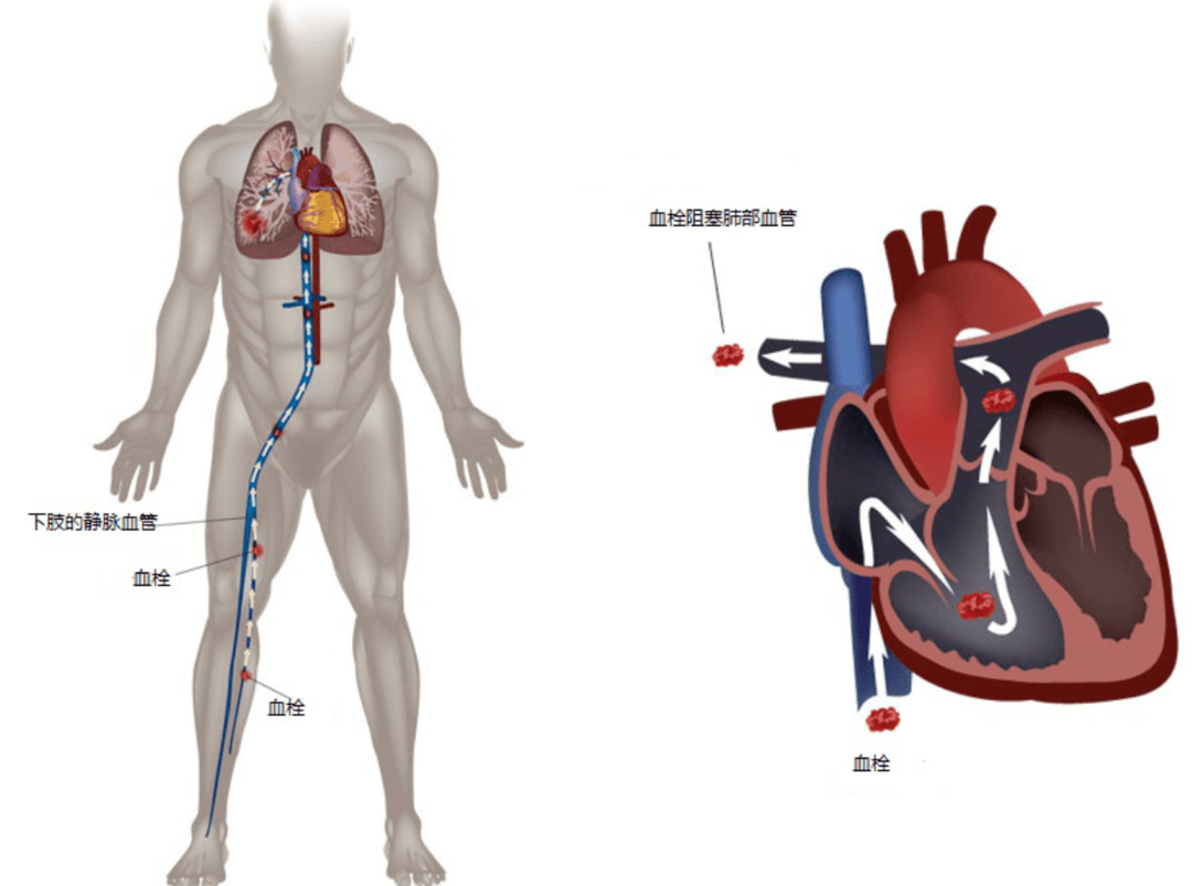 对于血栓高危疾病如人工瓣膜置换术后,房颤,肺栓塞,深静脉血栓等,需要