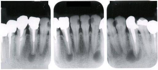 根管治疗策略是取决于其是否感染