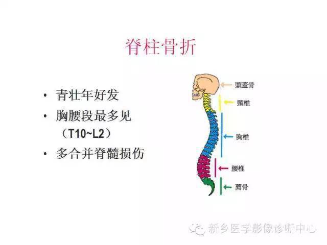 3 ,牵拉屈曲型(distractive flexion) 脊柱在屈曲位受伤,在安全带型的