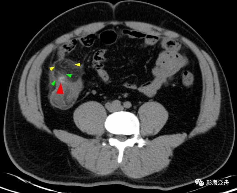 盲肠前壁的憩室炎,憩室内含高密度粪石影(红箭头),离憩室最近的地方即