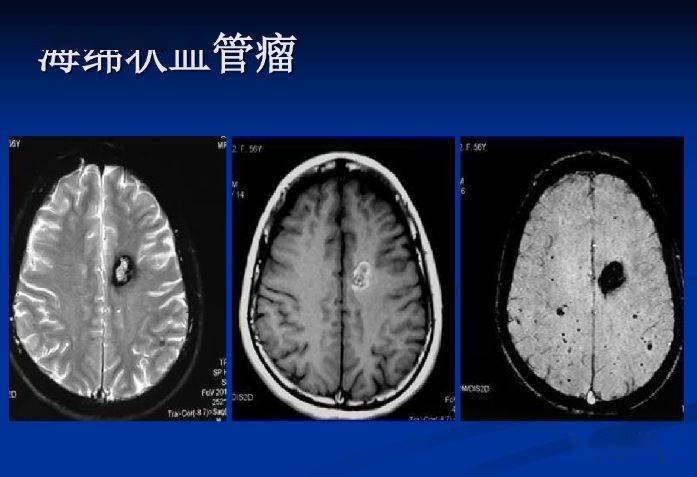 磁敏感加權成像(swi)詳細臨床應用_解剖圖