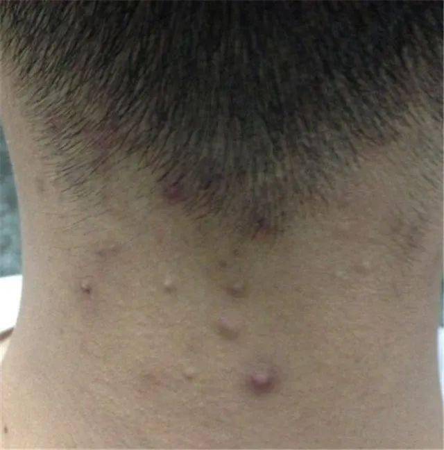 脖子肉多可以做手术吗 5a12dbc9eaac453d835c785b96228a0d.jpeg