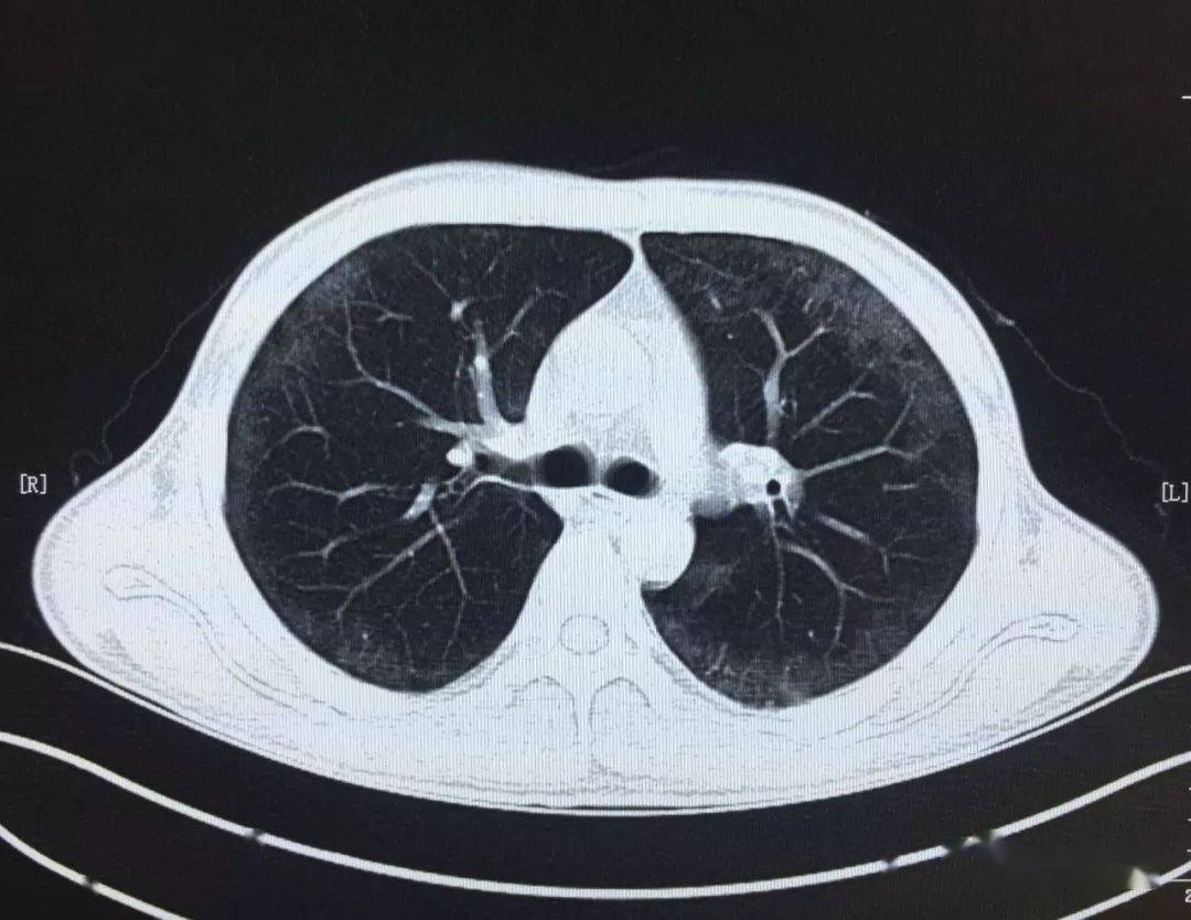 卡氏肺孢子菌肺炎