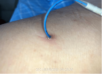 picc穿刺点并发淋巴漏液如何处理病例回顾