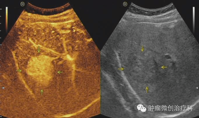 超声造影,是继实时灰阶超声(b超),彩色多普勒超声之后超声医学的第三