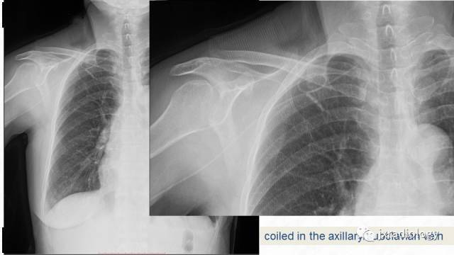 picc尖端的胸片定位