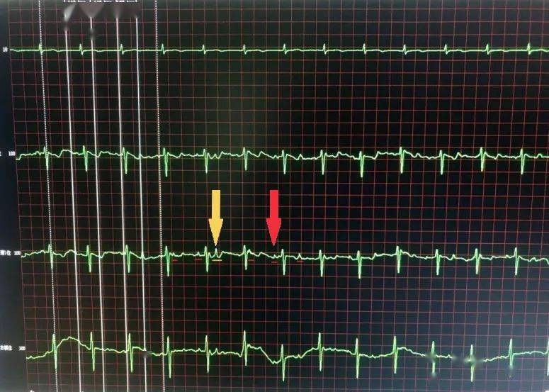 胎儿心电图检查是临床听诊及胎心监护不能替代的一种新