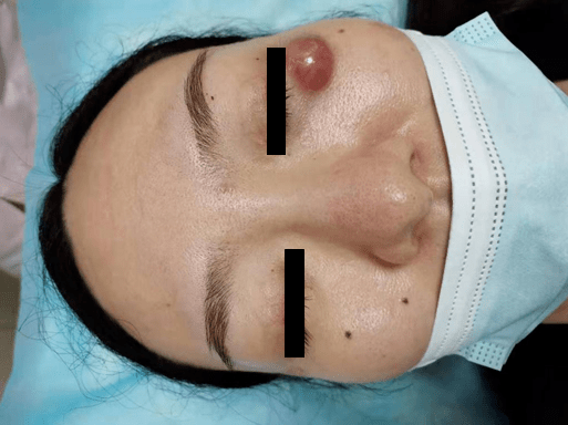 我院皮肤4科"火针"疗法您试过吗?