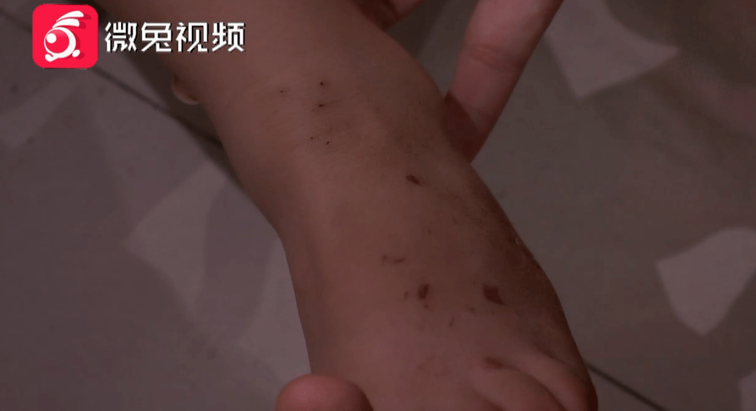 点燃|筋膜枪竟然会爆炸？！祖孙三人受伤，床单也被点燃！商家这样说