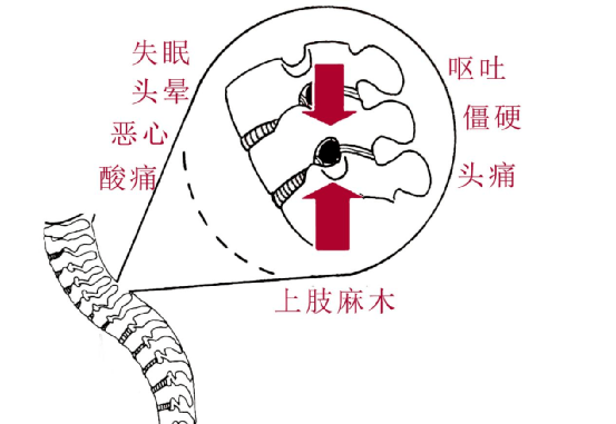 颈椎|身体的“警报”你收到了吗？