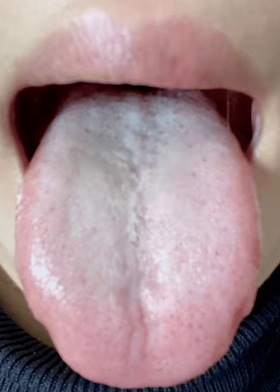 有淤点,舌质发青,舌下静脉粗——体内有淤血1,舌尖有很明显的淤点
