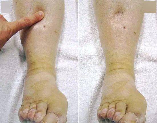 健康科普丨下肢深静脉血栓的防治常识