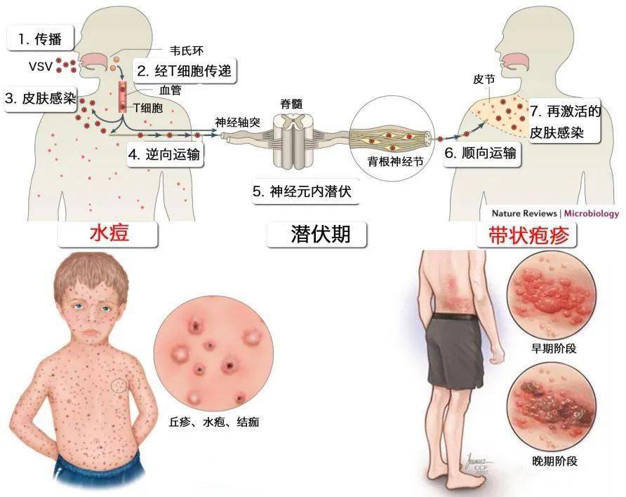 大肠疱疹症状前期图片图片