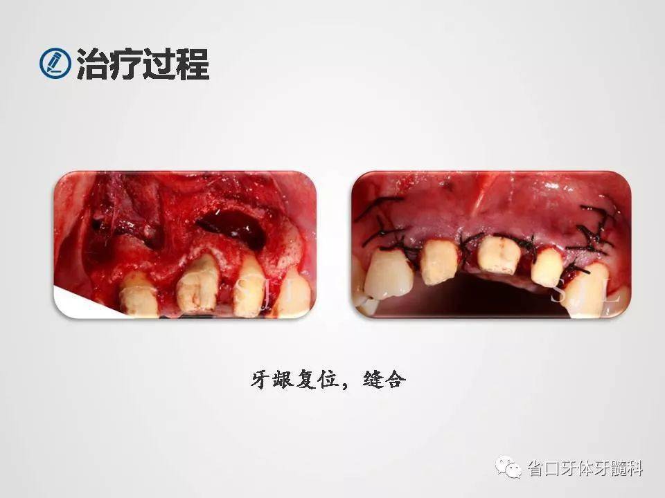 【病例分享】上颌前牙区显微根尖手术一例