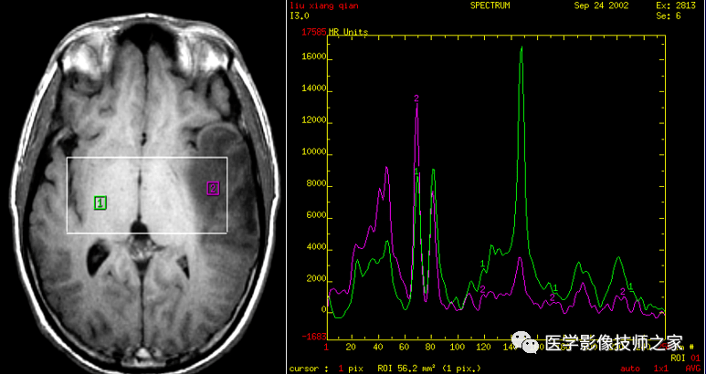 一文读懂!磁共振波普(mrs)检查