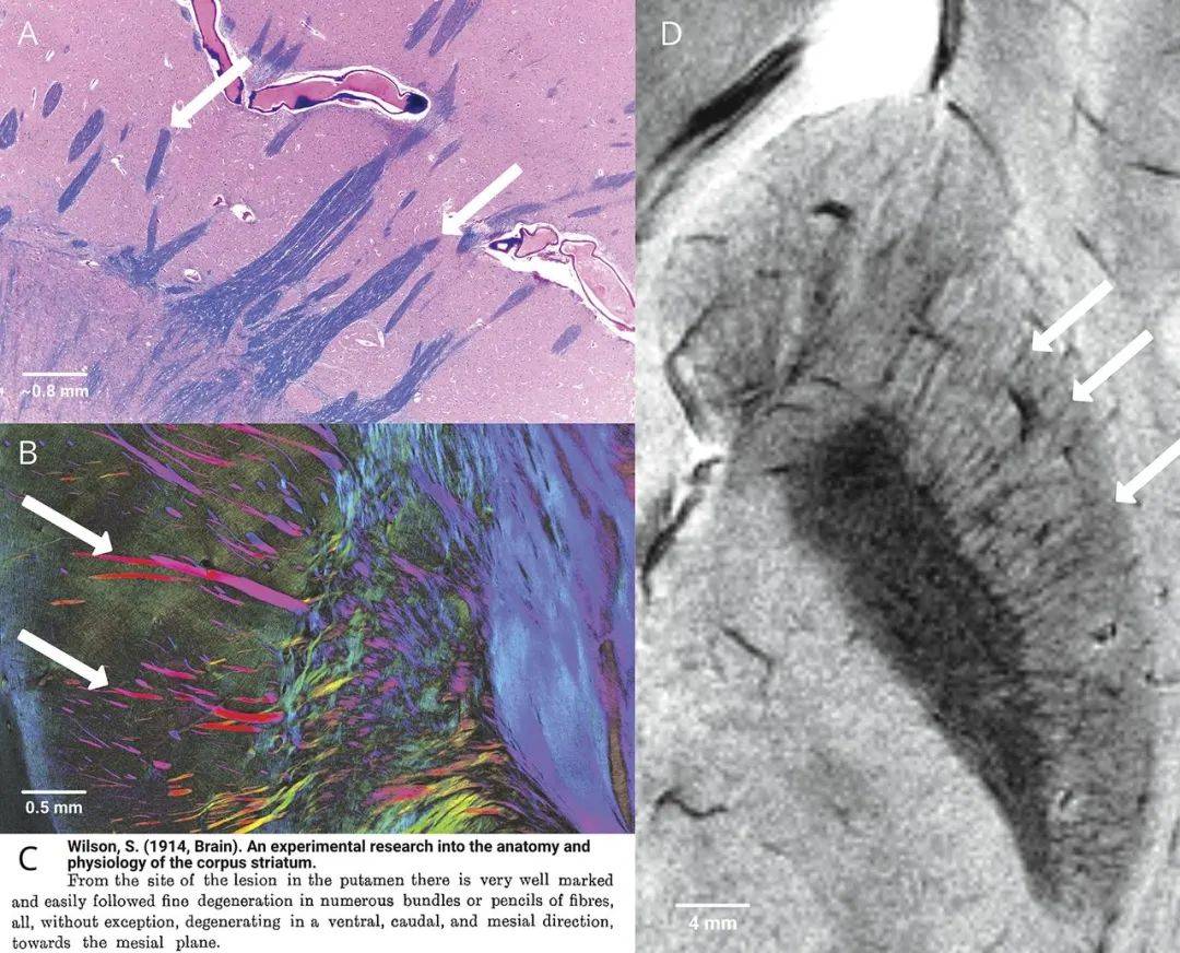 镇静剂|治疗帕金森：大脑深处，一颗核桃大小的谜团