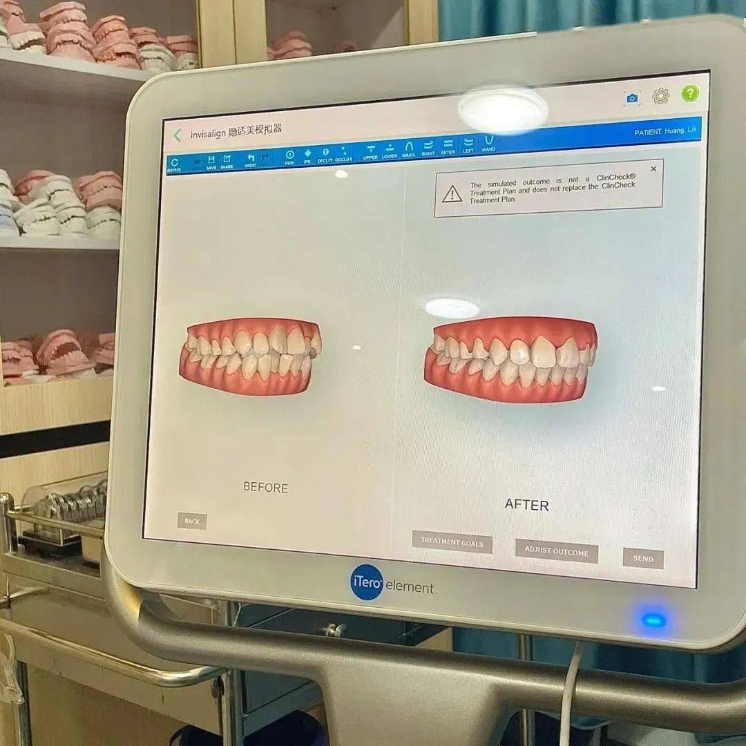初步面诊,建立档案后,医生会启用数字化itero口扫仪.