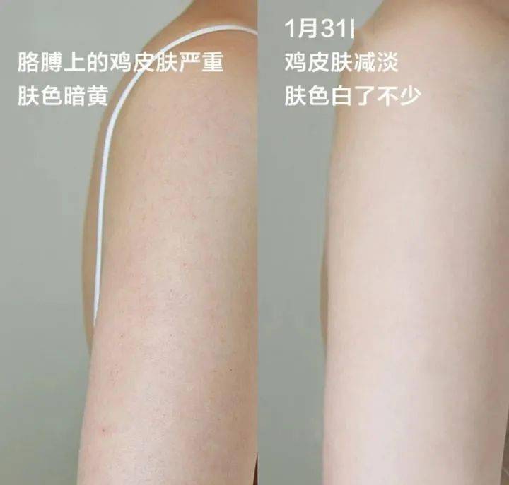 包含28个月孩子皮肤鸡皮咋办的词条