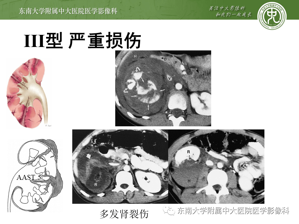 病例结果:右侧多发肾裂伤编辑/校对:郑孝飞增强ct男,46岁,因"外伤后