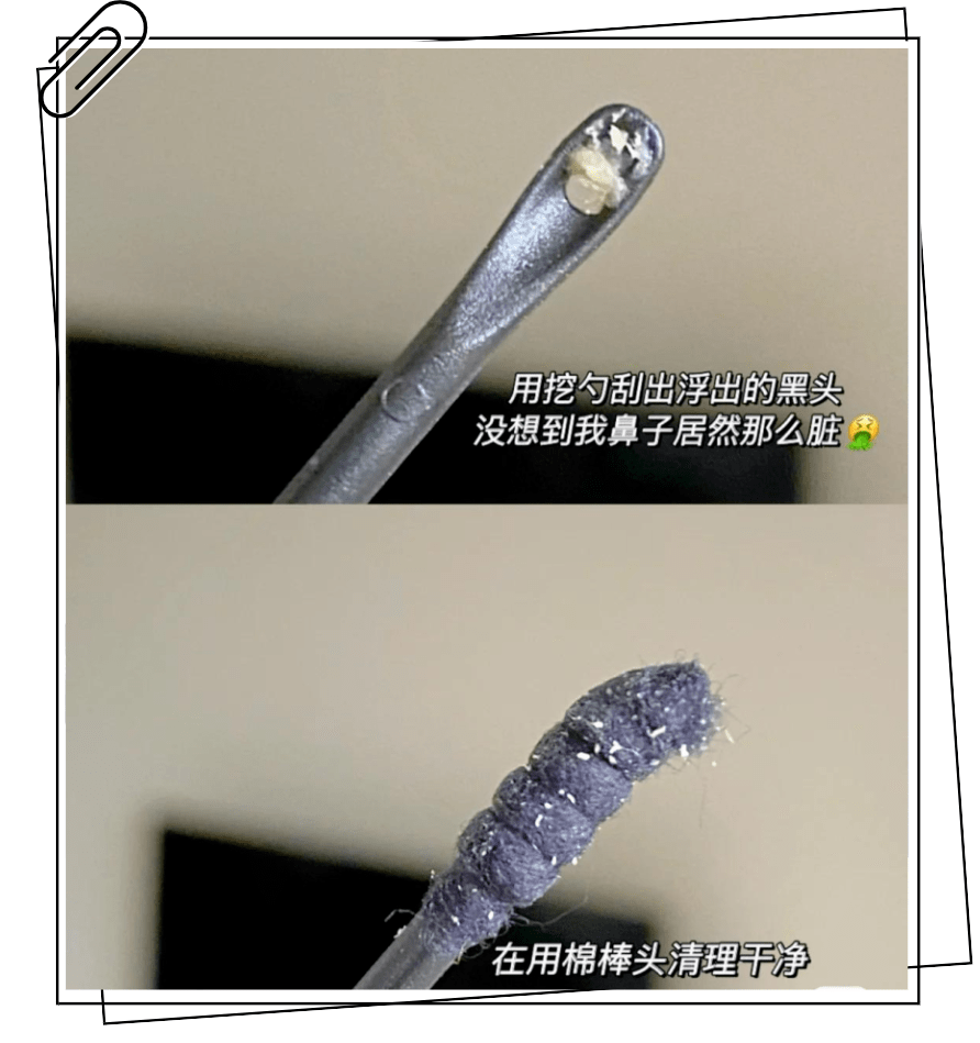 黑头|这张脸，我看了就想吐