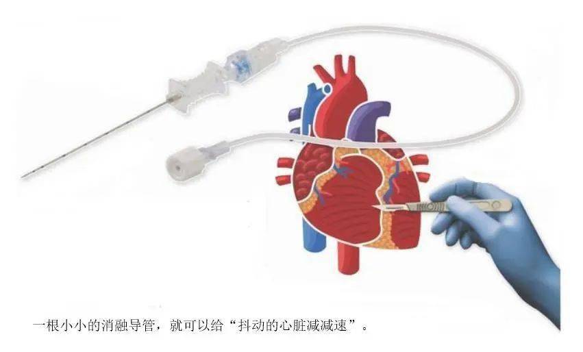 给抖动的心脏减减速射频消融术为房颤患者带来福音