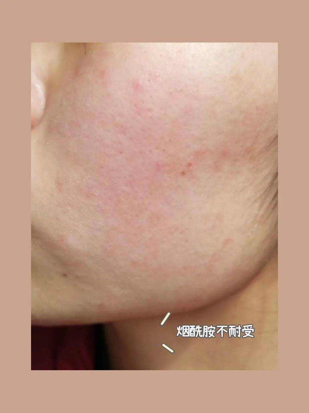 但由于烟酰胺刺激性较强,不少人会出现不耐受的情况:脸发痒泛红,刺痛