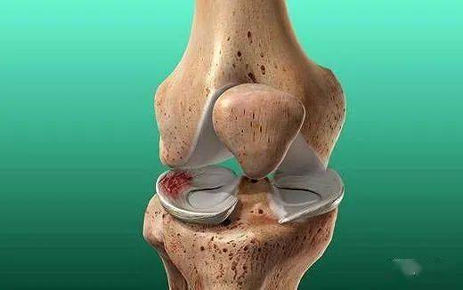 肿痛弹响打软腿运动障碍高度警惕膝关节软骨的损伤