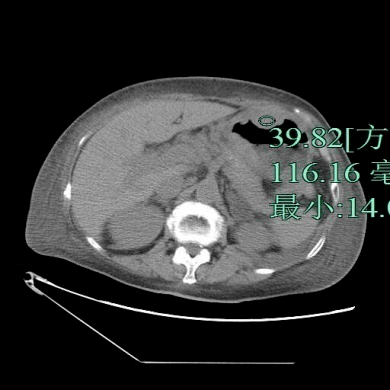 直肠|「放射沙龙Spark病例挑战41期」女性，87岁，因咳嗽气急1周、入院