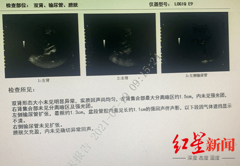 女子|输尿管结石竟能导致脓毒血症？成都女子忽视病情险酿大祸