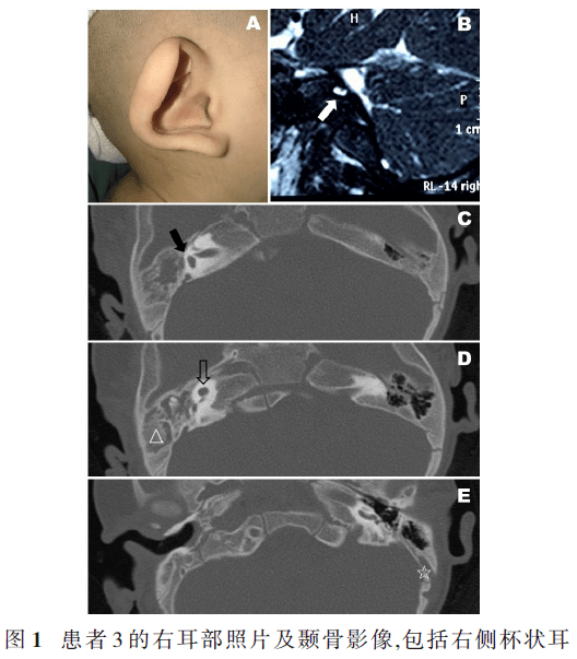 charge 综合征患者颞骨影像和临床特点_畸形
