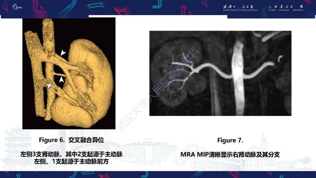 肾动脉分支解剖图片