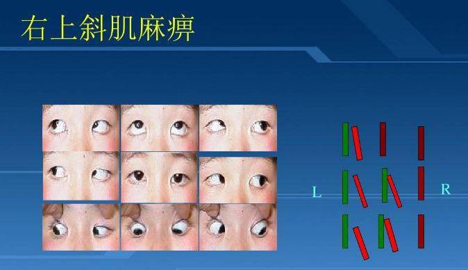 左眼上斜肌麻痹图片