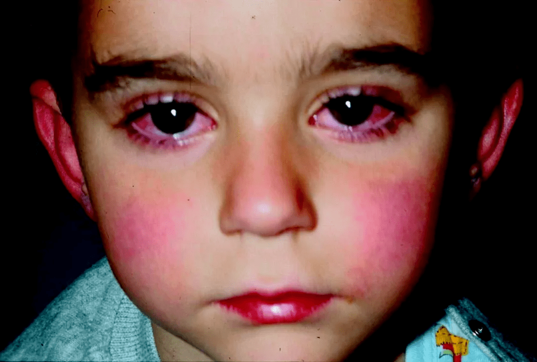 这就很容易引发眼睛疾病,最常见的是红眼病(即急性