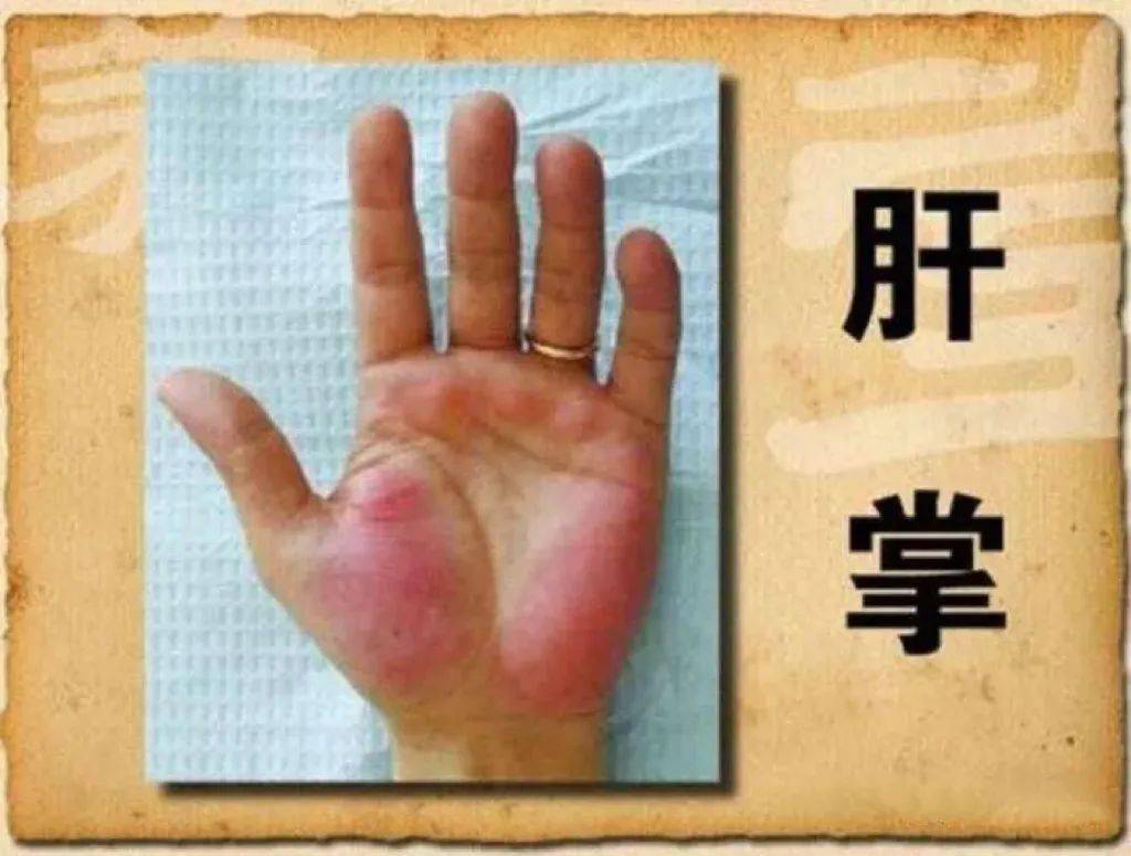 治疗|科普 | 从乙肝到肝硬化，需要多久？