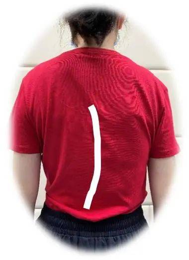 角度|简单辨别脊柱侧弯，避免孩子走“弯”路！