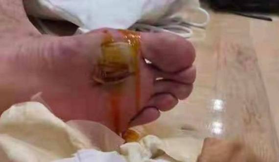 东京奥运会 张军 谌龙脚底大血泡影响了决赛发挥 新华社