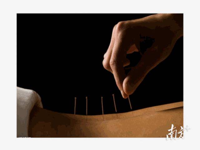 潘裕国|67岁阿婆自行针灸，却针断腹中！医生：擅自针灸有风险