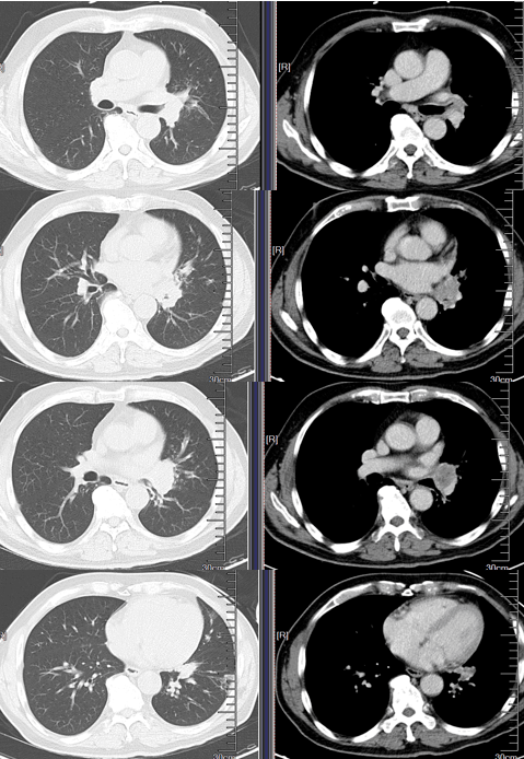 肺癌晚期症状ct图片图片