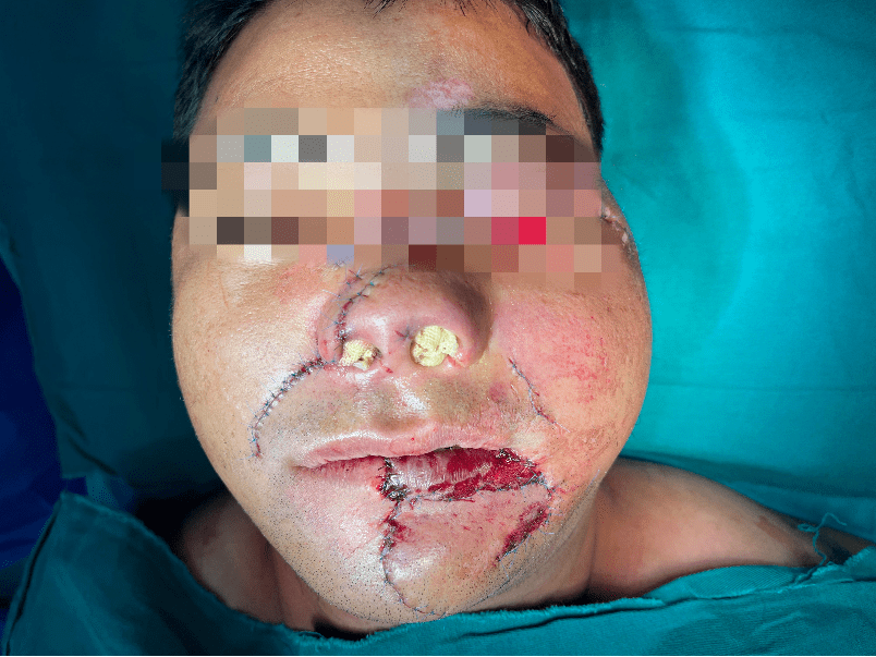 面部|警示丨宁夏男子骑摩托翻车，面部严重毁损，下唇几乎脱落！