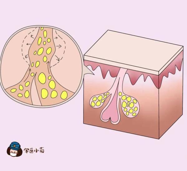 炎症|关于“痘痘”那些不得不说的事