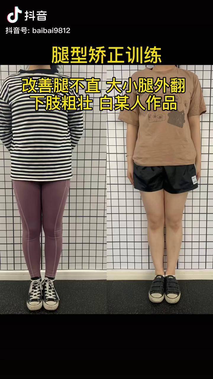 腿型非常重要腿不直自然会看着比较粗瘦小腿腿型矫正
