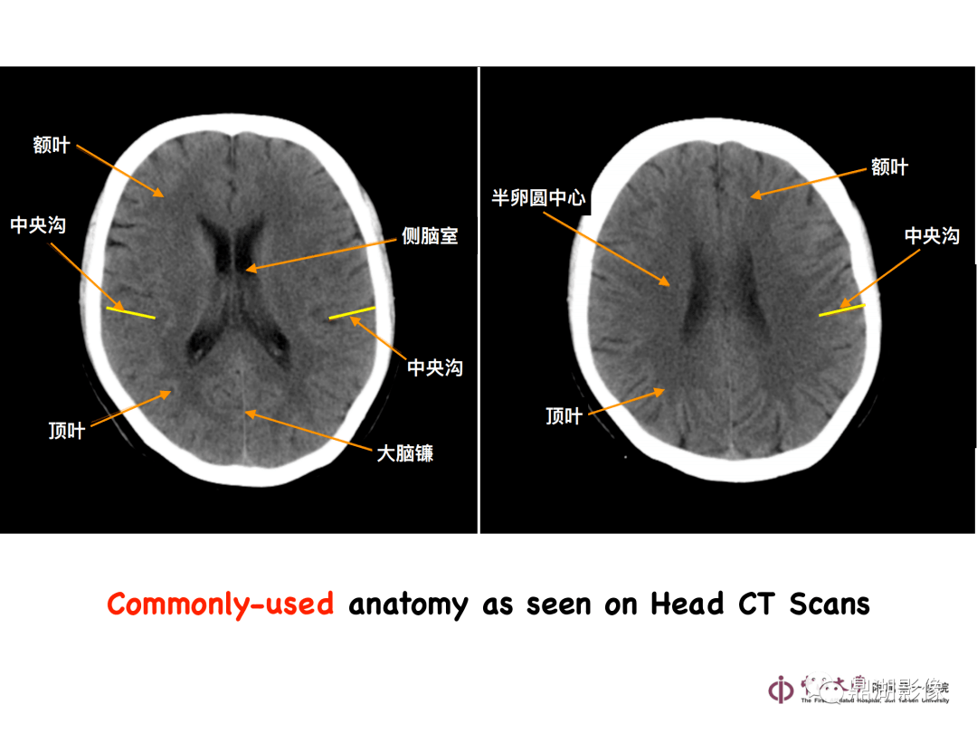 ct头颅扫描定位线图片图片