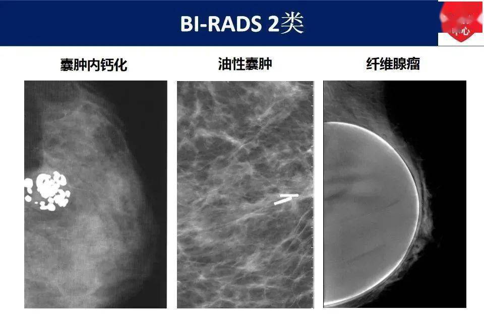 最新版乳腺x線birads分類解讀