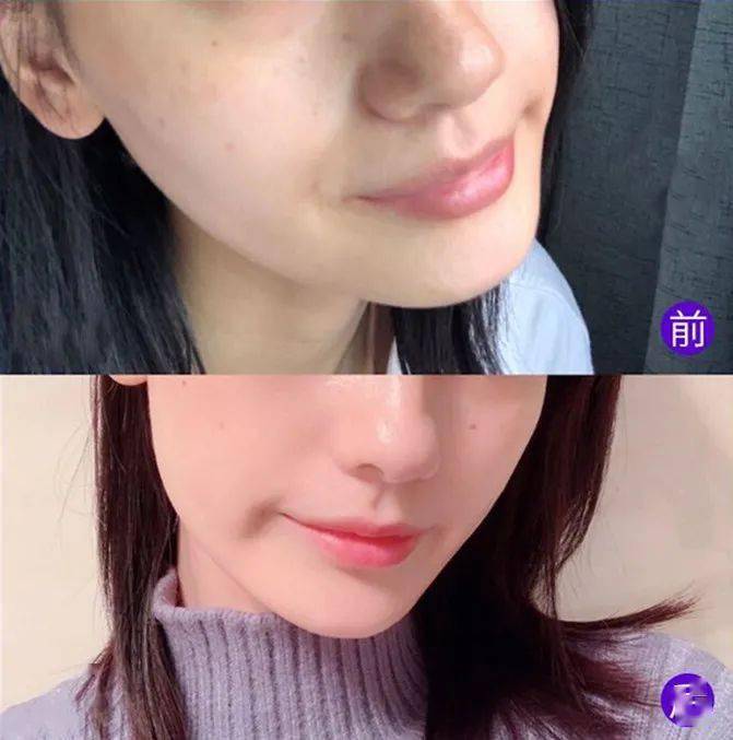 水光针只打一次没效果那打多次会过敏吗