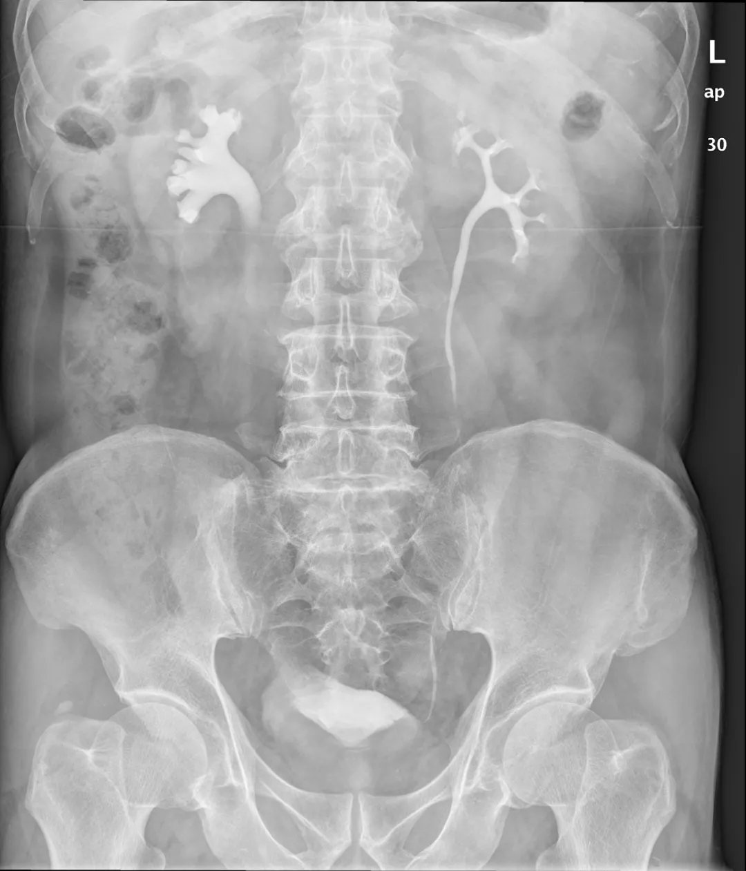 这类患者不要误诊为肾积水