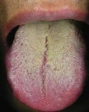 脉象|黄连温胆汤——清化痰热，宁心安神