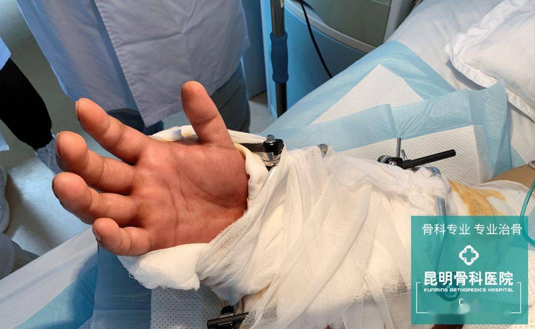 昆骨手足显微外科:以精湛医术和硬核担当再续患者"手足情"_手术